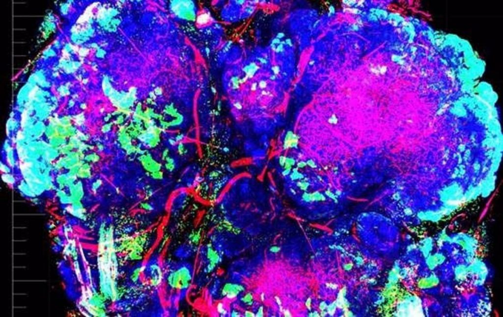 Spanish researchers discover a "weak spot" in tumors resistant to many drugs